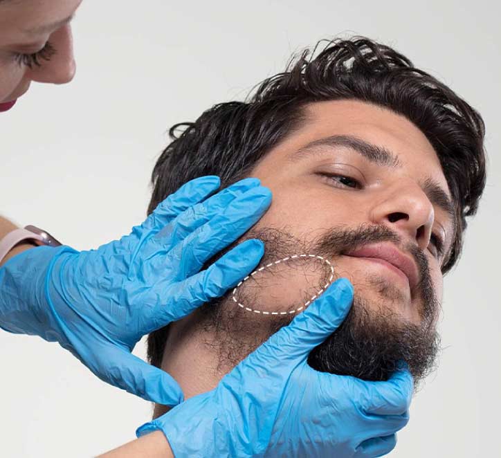 Beard Transplant