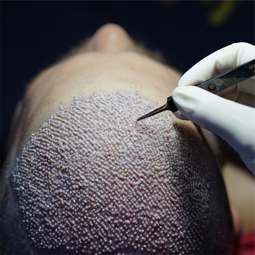 Sapphire Hair Transplant