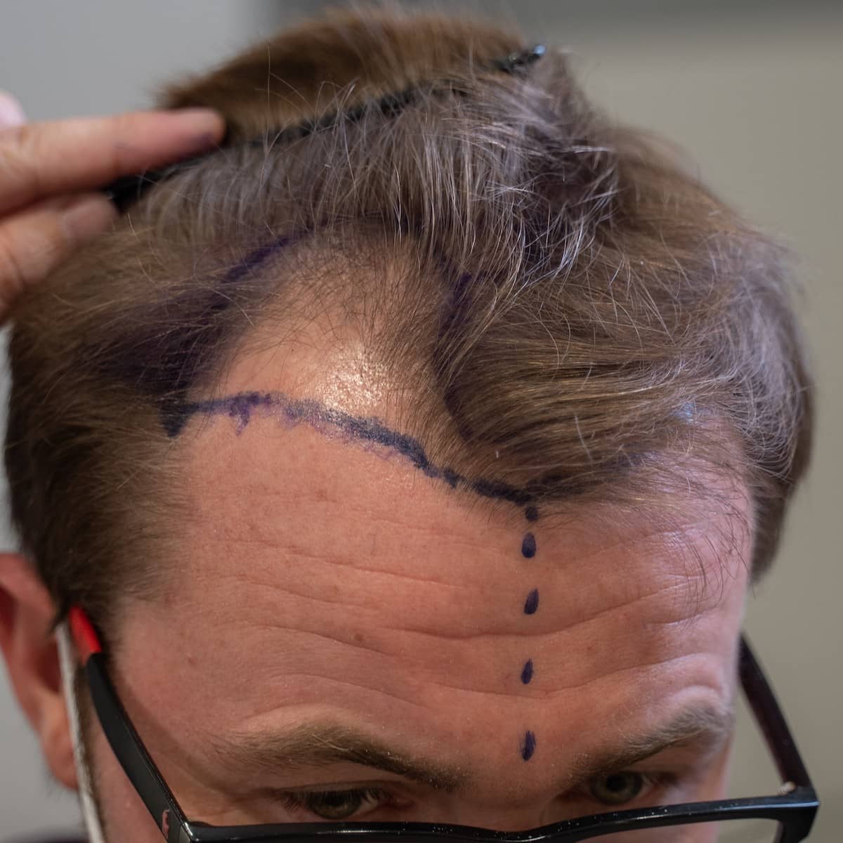DHI Hair Transplant