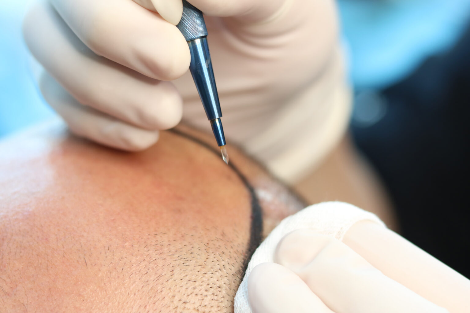 FUE Hair Transplant