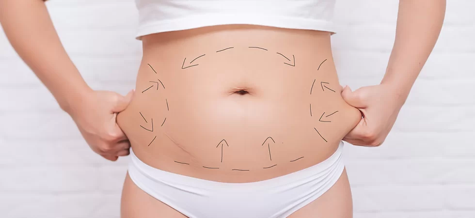 Tummy Tuck (Abdominoplasty)